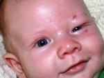 Penyakit Mata Ptosis Pada Anak