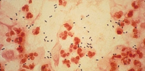 Gambar Bakteri Streptococcus Pneumoniae Penyebab Meningitis