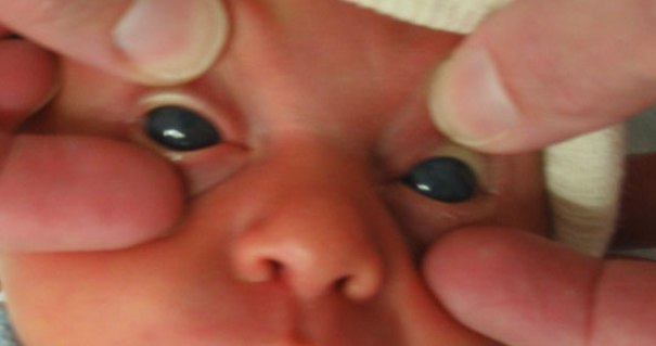 Gambar Penyakit Glaukoma Pada Bayi